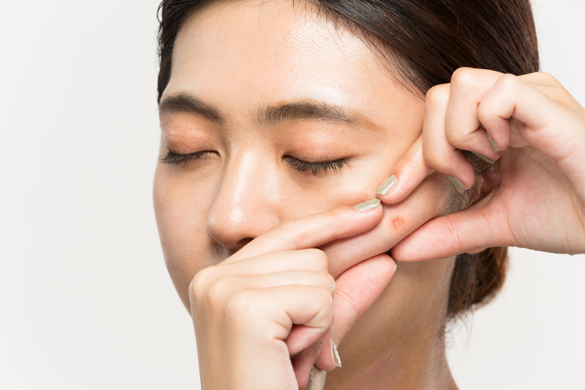 ニキビを繰り返さない肌 | 大阪府江坂のエステなら美脳小顔矯正＆毛穴洗浄サロン GRACE 江坂