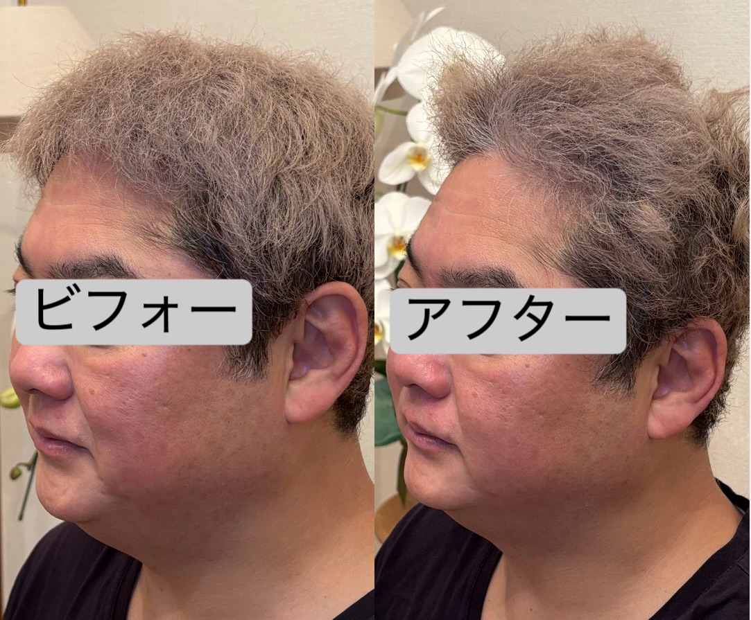 毛穴洗浄で透明感のある肌に