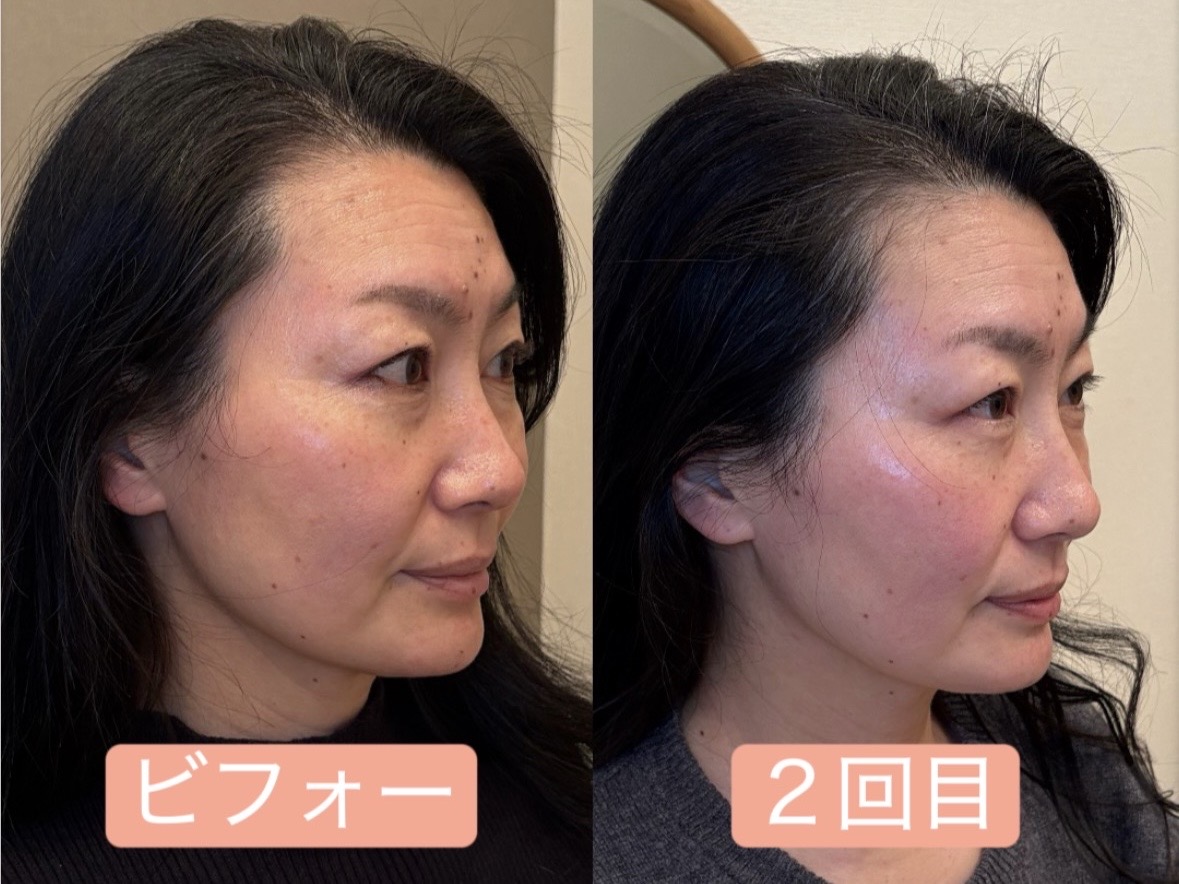 柔らかさと透明感を引き出す小顔矯正
