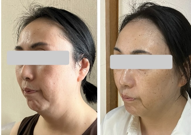 自宅でできる！エラ張りケアの3つの方法