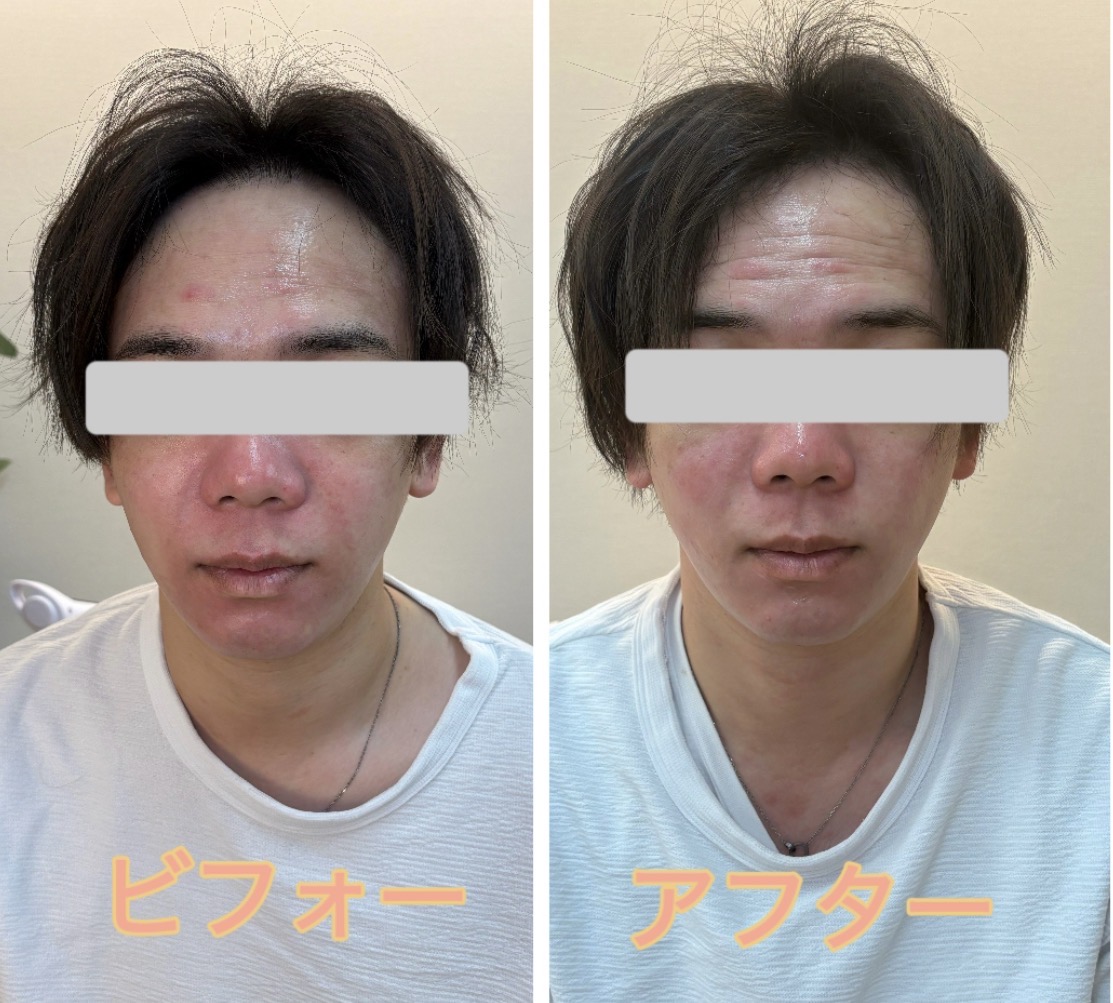 施術後のケアと持続効果